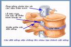 Hẹp lỗ liên hợp là gì vì sao cần mở rộng