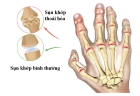 Chữa đau nhức xương khớp bàn tay, ngón tay thế nào