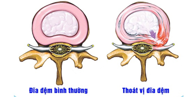 thoat-vi